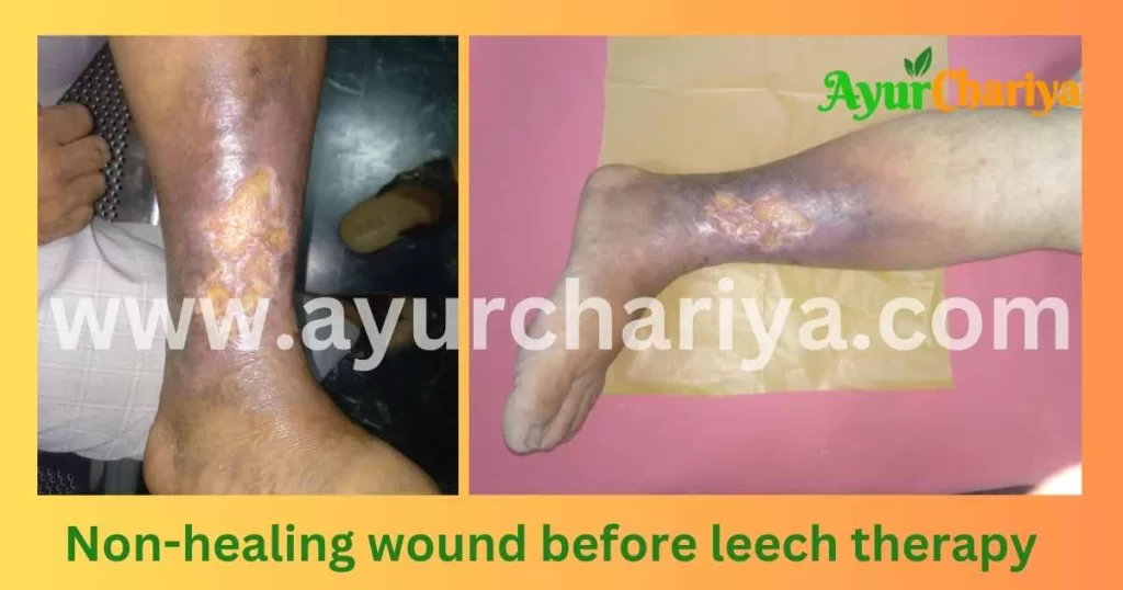Non-healing wound before leech therapy